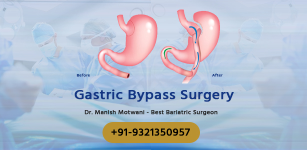 Gastric Bypass Surgery in Mumbai - Cost & Procedures (2024)