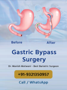 Gastric Bypass Surgery in Mumbai - Cost & Procedures (2024)