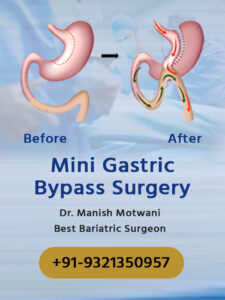 Mini Gastric Bypass / Weight Loss Treatments - Cost & Procedures