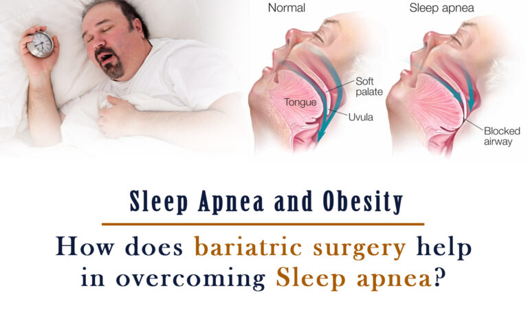 Sleep Apnea and Obesity
