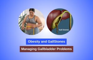 Obesity and GallStones - Managing Gallbladder Problems