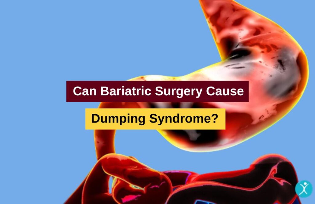 can-bariatric-surgery-cause-dumping-syndrome