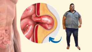 hernia and obesity