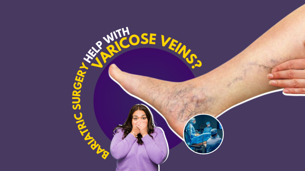 Does bariatric surgery help with varicose veins