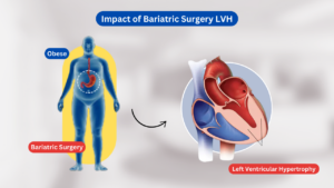 Impact of Bariatric Surgery LVH